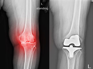 Protesi di ginocchio a seguito di artrosi