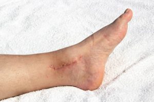 Frattura di caviglia: Riabilitazione a seguito di intervento chirurgico